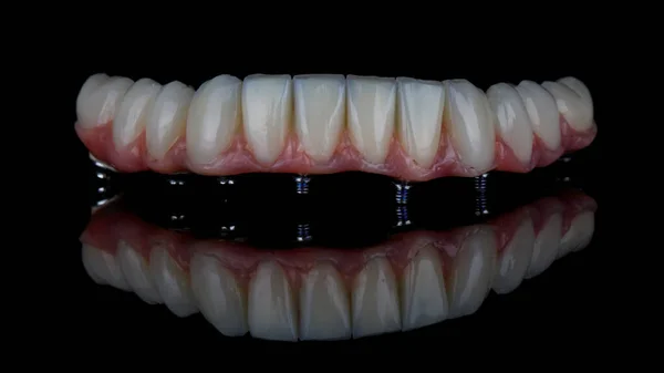 黒い背景に下顎のピンク色の歯茎を持つセラミック製の歯科用義歯 — ストック写真