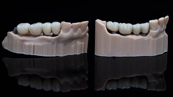 Duas Pontes Dentárias Com Feixe Modelos Feitos Uma Impressora Filmado — Fotografia de Stock
