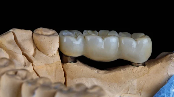Οδοντική Γέφυρα Για Τρία Δόντια Από Ζιρκόνιο Στο Μοντέλο — Φωτογραφία Αρχείου