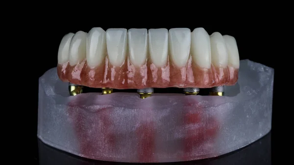 Prótesis Mandíbula Inferior Temporal Con Encía Rosa Modelo Resina Disparada — Foto de Stock