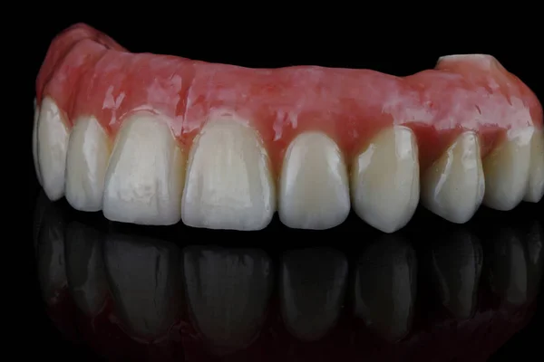 Dental Prosthesis Upper Jaw Made Metal Ceramic Pink Gums Black — Stock Photo, Image