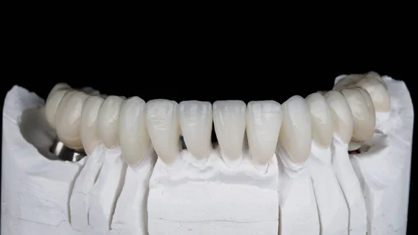 Folheados Dentários Finos Coroas Cerâmica Modelo Fotografado Contra Fundo Preto — Fotografia de Stock