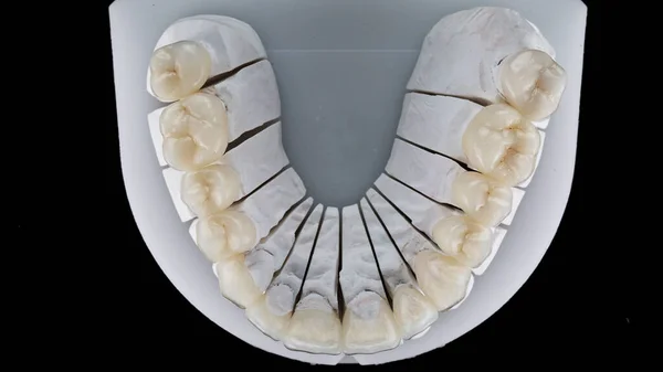 Yüksek Güçlü Seramik Kaplamalı Diş Modeli Siyah Arka Planda Üst — Stok fotoğraf