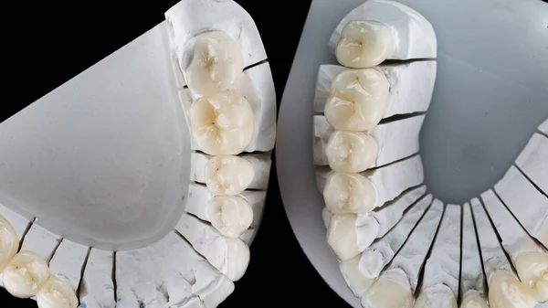 composition of dental crowns made of ceramics on models, view of the morphology from above