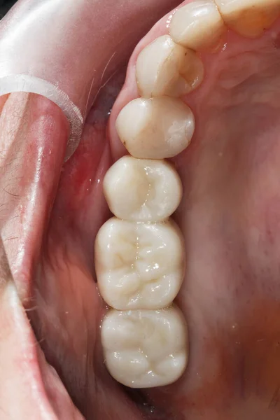 installed dental bridge made of zircon in the patient\'s oral cavity