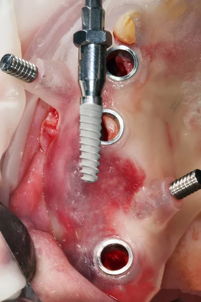 Impianto Dentale Prima Dell Inserimento Attraverso Uno Speciale Modello Chirurgico — Foto Stock