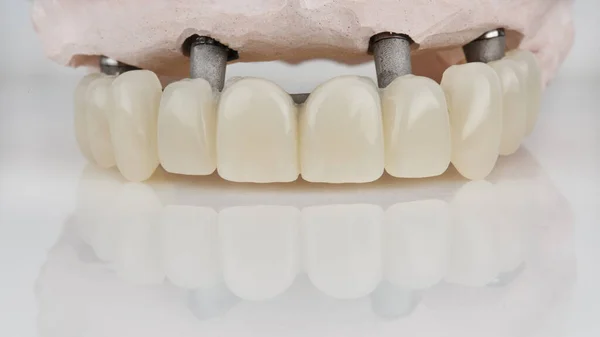 Protesi Dentaria Della Mandibola Superiore Temporanea Una Barra Con Modello — Foto Stock