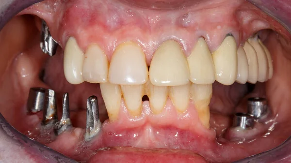 Προβλήματα Εμφυτεύματα Και Αφαιρούμενες Οδοντικές Κορώνες Στο Στόμα Του Ασθενούς — Φωτογραφία Αρχείου
