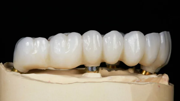 Prótesis Dental Hecha Circón Sobre Fondo Negro Vista Lateral Modelo —  Fotos de Stock