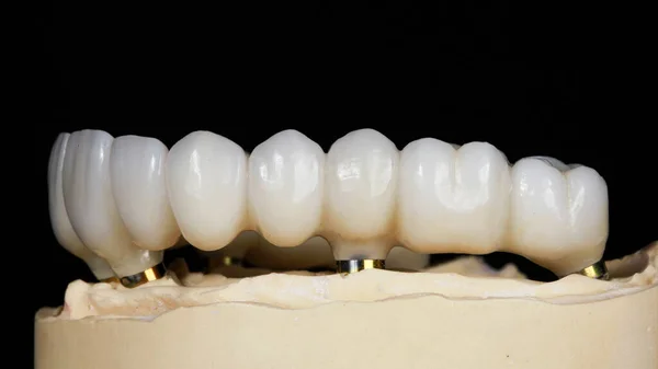 Prótesis Dental Hecha Materiales Calidad Sobre Fondo Negro Vista Lateral —  Fotos de Stock