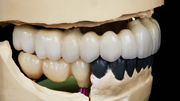 Prótese Dentária Zircão Maxilares Superiores Inferiores Modelo Vista Lateral — Fotografia de Stock