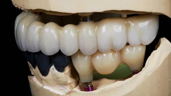 Dental Prosthesis Made High Quality Materials Large Prostheses — Stock Photo, Image