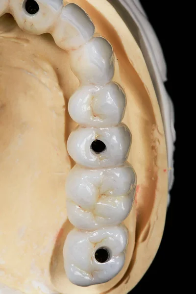 Parte Denti Masticare Protesi Dentali Materiali Qualità Vista Dall Alto — Foto Stock