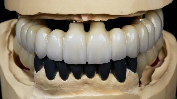 石膏模型上的锆石上颚和下颚假牙 — 图库照片