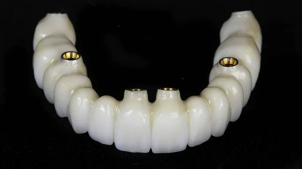 Prótese Dentária Feita Zircão Com Fixação Seis Implantes Vidro Preto — Fotografia de Stock