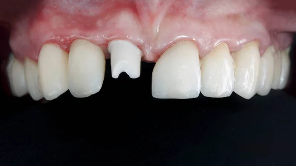 基地は歯前歯の歯冠の設置の基礎です — ストック写真