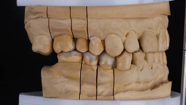 セラミックベナープレート付き歯科モデル — ストック写真