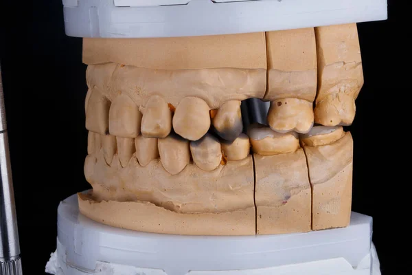 噛んだ歯にセラミックインレイを塗るモデル — ストック写真