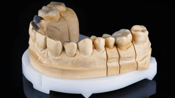 歯の顎とセラミックのタブの歯科モデルを黒い背景で撮影しました — ストック写真