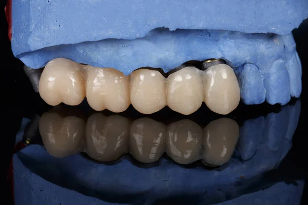 Prótese Dentária Temporária Polímero Espelho Preto — Fotografia de Stock