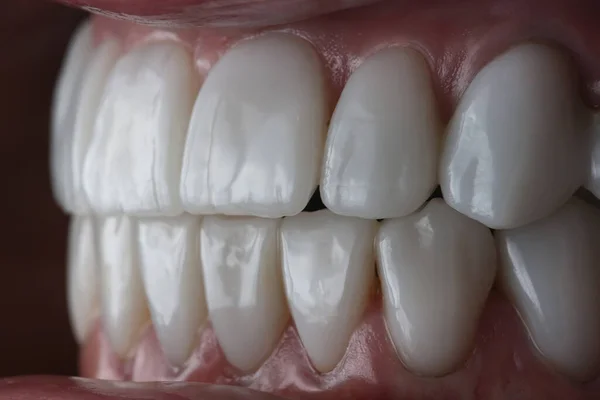 Αισθητικές Τελικές Κεραμικές Κορώνες Στο Στόμα — Φωτογραφία Αρχείου