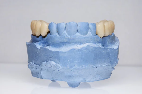 一時的な冠を持つ歯科矯正のための青い歯科モデル — ストック写真