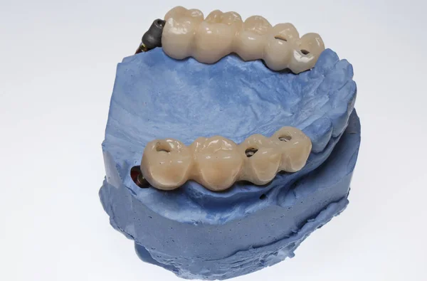Временные Зубные Протезы После Имплантации Жевательных Зубов Пациента — стоковое фото