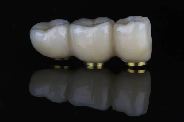 Prótesis Dental Tres Implantes Para Restaurar Función Masticación —  Fotos de Stock