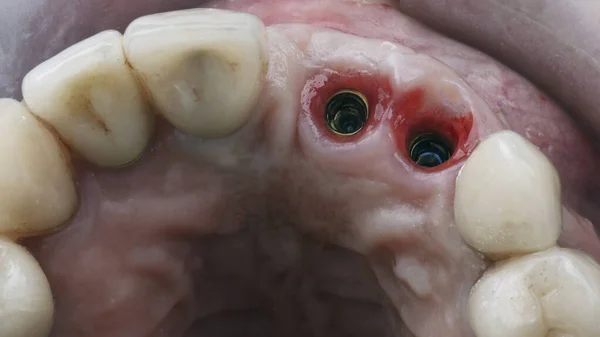 歯肉粘膜に埋め込まれた2つのインプラントを鏡で見ることができます — ストック写真