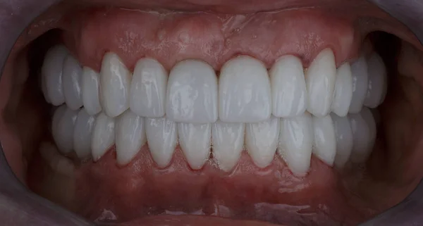 Okleiny Ceramiczne Wszystkie Zęby Jamie Ustnej — Zdjęcie stockowe