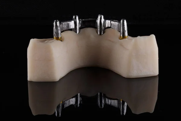 Dental Model Titanium Prosthetic Beam Showing Reverse Side Beam — Stock Photo, Image