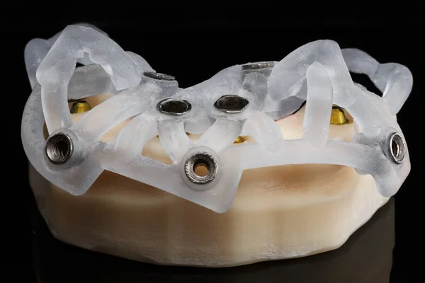 Modelo Cirúrgico Para Implantação Dentária Alta Precisão — Fotografia de Stock
