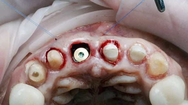 ガムボリューム用前歯の注入後の軟組織の縫合と追加 — ストック写真