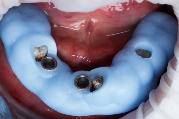 Modèle Chirurgical Bleu Polymère Dans Bouche Patient Avant Implantation Précise — Photo