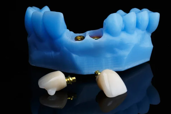 Korona Dentystyczna Model Stomatologiczny Kolorze Niebieskim Pokazane Mocowanie Elementy Czarnym — Zdjęcie stockowe