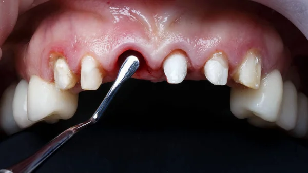 Εξαχθέν Οδοντιατρικό Και Χειρουργικό Όργανο — Φωτογραφία Αρχείου
