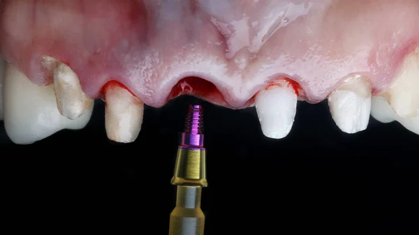 Specjalne Złącze Chirurgiczne Implantacji Przedniego Zęba Czarnym Tle — Zdjęcie stockowe
