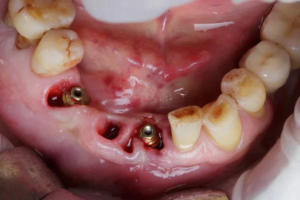 Χειρουργική Οδοντιατρική Επέμβαση Τοποθέτηση Της Βάσης Μετά Την Εμφύτευση Και — Φωτογραφία Αρχείου