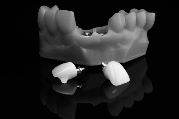 Corona Dental Modelo Dental Muestra Montaje Componentes Vidrio Negro Tiro —  Fotos de Stock
