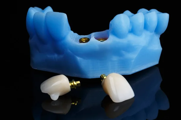 Coroa Dental Modelo Dental Azul Mostrado Montagem Componentes Vidro Preto — Fotografia de Stock