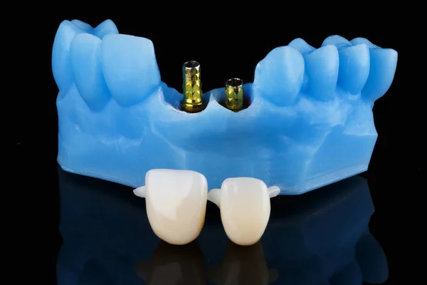 Modelo Dentário Impressora Pilares Ouro Padrão Com Coroas Para Instalação — Fotografia de Stock