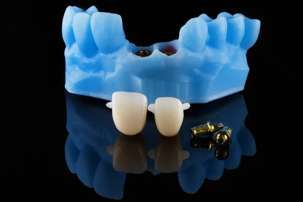 Modelo Dentário Pilares Ouro Padrão Com Coroas Para Montagem Pilares — Fotografia de Stock