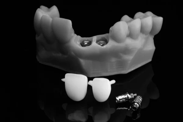 Zubní Model Standardní Zlaté Ozdoby Korunami Pro Upevnění Černé Skleněné — Stock fotografie
