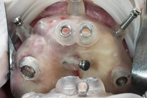 Modello Chirurgico Dentale Nella Cavità Orale Impianto Quattro Impianti — Foto Stock