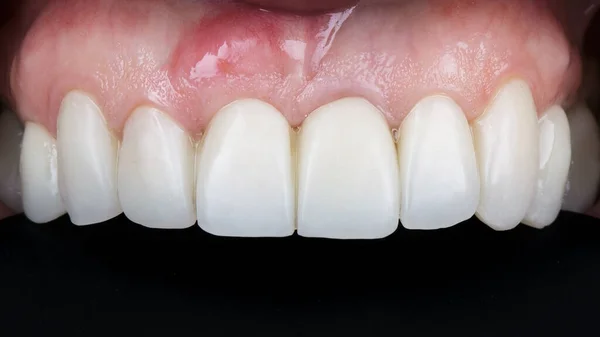着床後の復元された美しい歯茎と王冠 — ストック写真