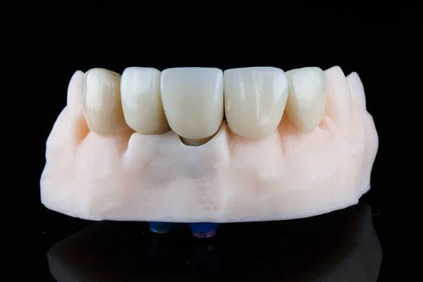 Duas Coroas Dentárias Alta Precisão Protocolo Digital Modelo — Fotografia de Stock