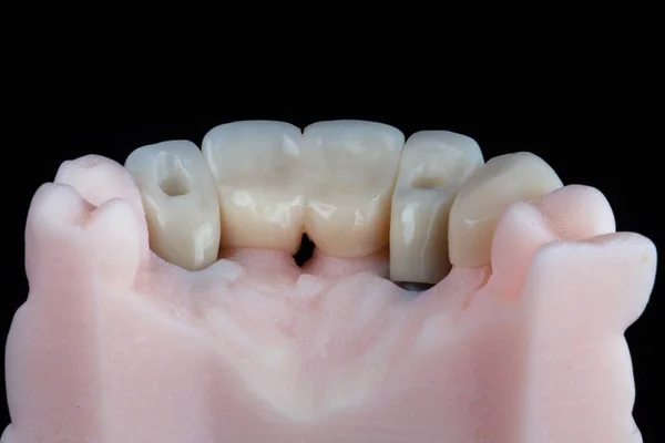 Korony Dentystyczne Przednie Zęby Modelu Wewnątrz — Zdjęcie stockowe