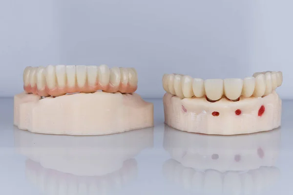 Prótesis Dentales Partidas Alta Calidad Dos Modelos Diferentes — Foto de Stock