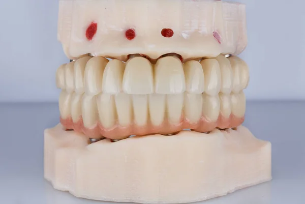 Modelo Dental Prótesis Dentales Donde Muestra Mordida Correcta Vista Desde — Foto de Stock