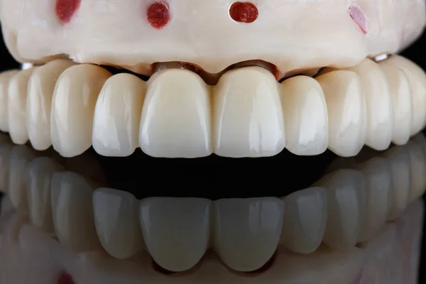Λευκασμένη Οδοντιατρική Πρόθεση Στο Μοντέλο Αντανάκλαση — Φωτογραφία Αρχείου